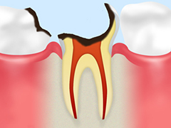 C4　末期のむし歯