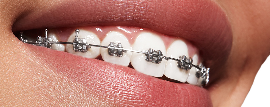 ハート歯科クリニックの矯正治療の特徴