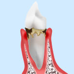 中等度の歯周病